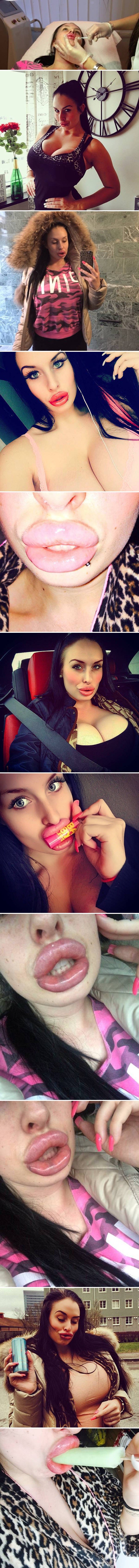 OVISNICA O INJEKCIJAMA Žena koja je brutalno napumpala usne uvjerena je da je zgodna, no malo njih se slaže s tim