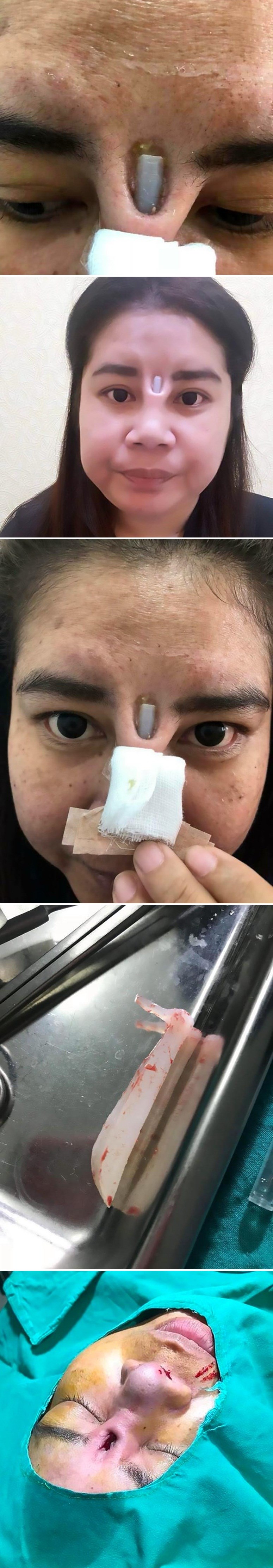 Ova žena je žrtva jedne od najgorih operacija nosa ikad, pogledajte što su joj doktori učinili