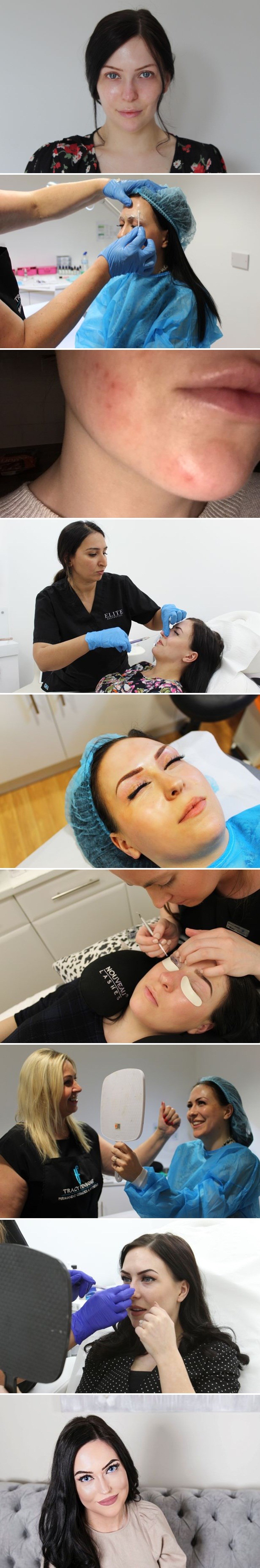 Žena je potrošila 35 000 kn na estetske zahvate kako bi prije dana vjenčanja promijenila svoje lice