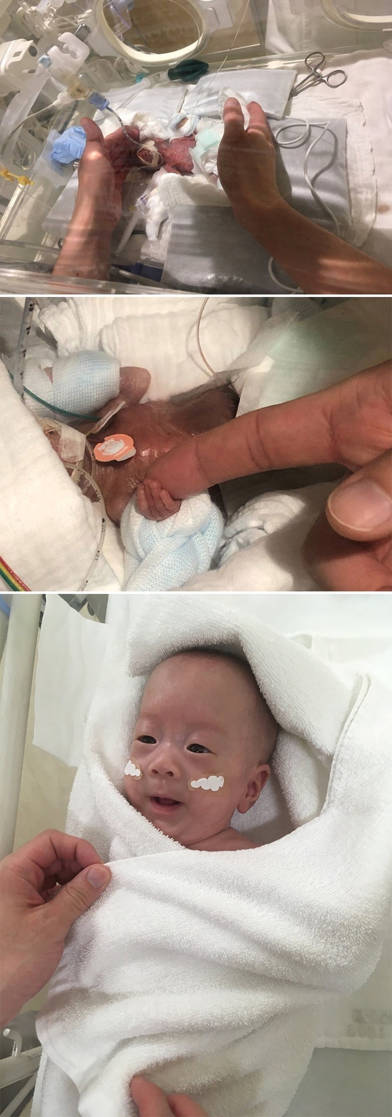 Ova beba je bila veličine kruške jer je rođena prerano, pogledajte kako izgleda danas