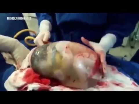 VIDEO Roditelji snimili čudesno rođenje kakvo se događa samo jednom u 80 000 slučajeva