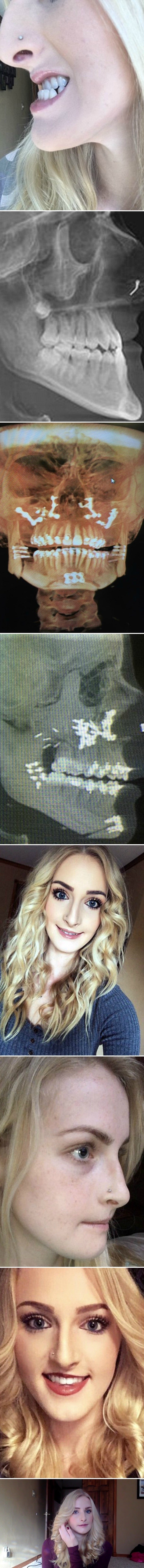 Rugali su joj se zbog deformirane čeljusti, a nakon operacije, sve se promijenilo 