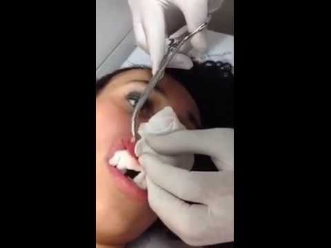 Gornja usna ju je prvo svrbila, zatim je natekla, a onda je djevojka shvatila da u sebi ima stanara!