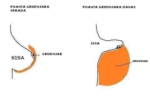 Crtež prikazuje kako su se grudnjaci nosili nekada i kako se nose danas