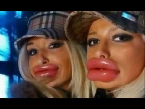 VIDEO Deset žena koje su definitivno pretjerale s povećavanjem usana!