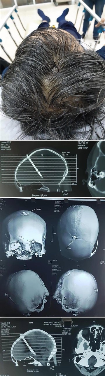Muškarac stigao u bolnicu zbog jakih glavobolja, doktori su ostali šokirani kad su vidjeli što se dogodilo